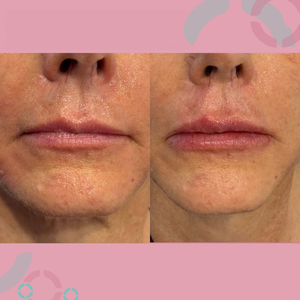 Facial Injectables 5 - Evolve Plastic Surgery